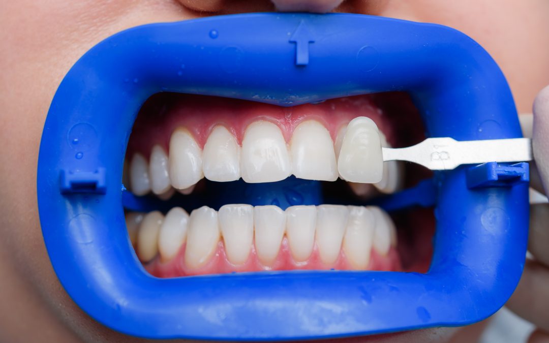 Blanqueamiento dental en Almería