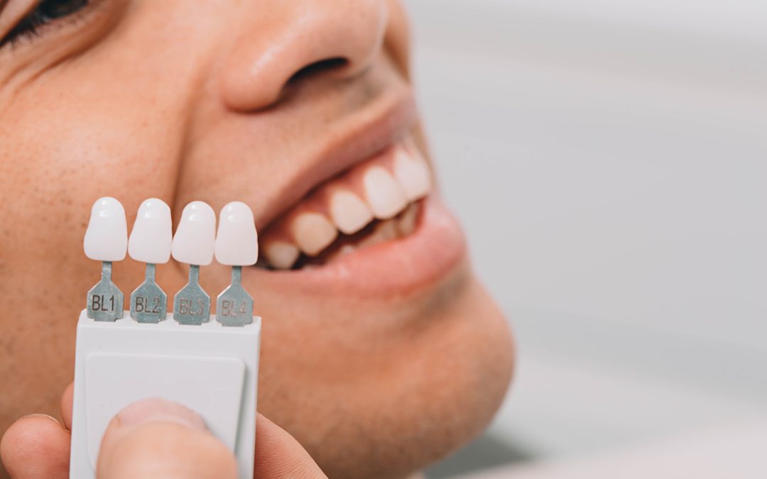 Beneficios de las carillas dentales para transformar tu sonrisa