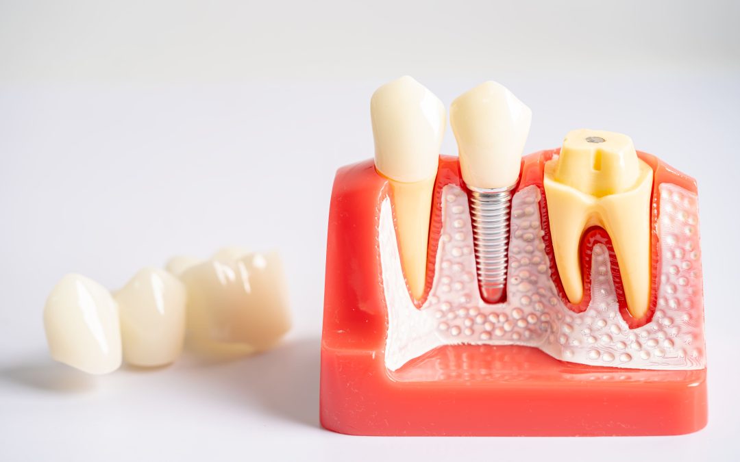 31. Cómo evitar la pérdida ósea tras la extracción de un diente en Almería